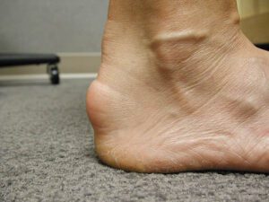 heel spur pain