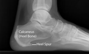 heel spur pain