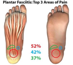 plantar