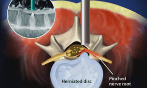 herniated disc