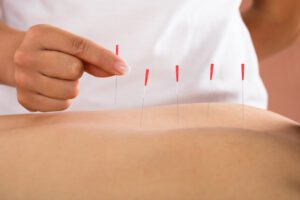 Person Receiving Acupuncture