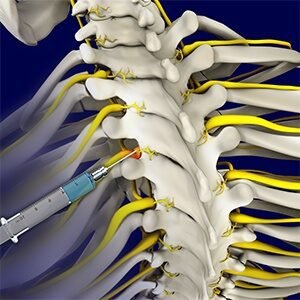 selective-nerve-root-block